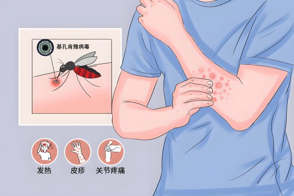 牛股远期策略 基孔肯雅热vs登革热：3个关键区别，看完秒懂！